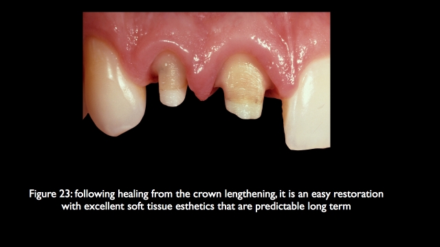 The Challenge of Replacing Missing Central and Lateral Incisors Frank Spear The Challenge of Replacing Missing Central and Lateral Incisors Figure 23