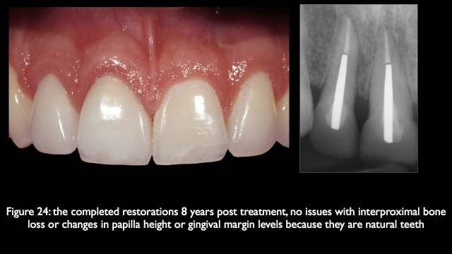The Challenge of Replacing Missing Central and Lateral Incisors Frank Spear The Challenge of Replacing Missing Central and Lateral Incisors Figure 24