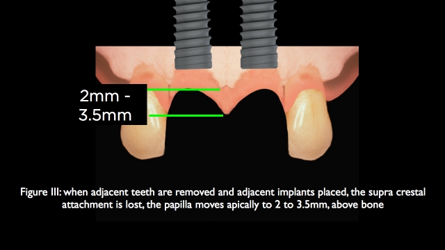 The Challenge of Replacing Missing Central and Lateral Incisors Frank Spear The Challenge of Replacing Missing Central and Lateral Incisors Figure 3