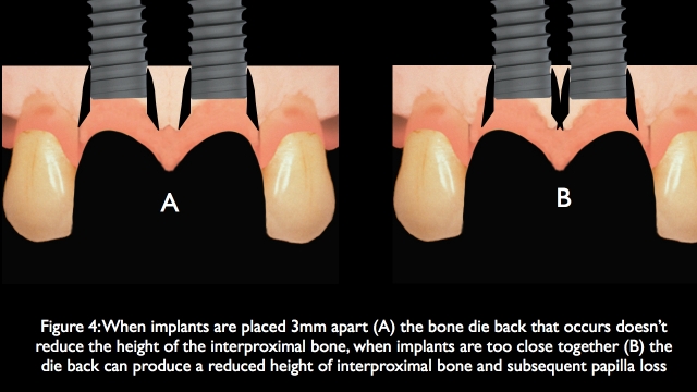 The Challenge of Replacing Missing Central and Lateral Incisors Frank Spear The Challenge of Replacing Missing Central and Lateral Incisors Figure 4