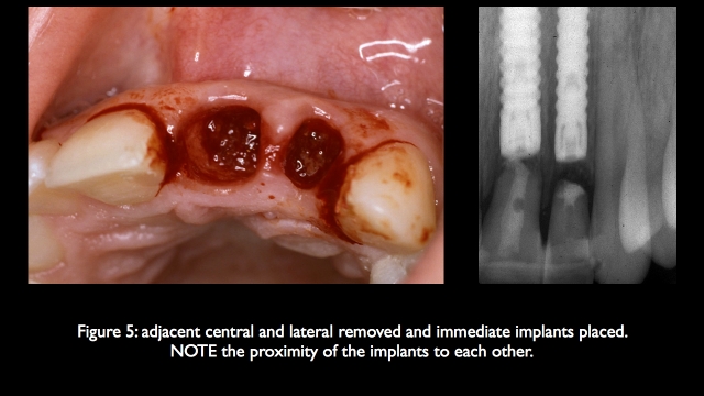 The Challenge of Replacing Missing Central and Lateral Incisors Frank Spear The Challenge of Replacing Missing Central and Lateral Incisors Figure 5