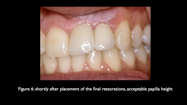 The Challenge of Replacing Missing Central and Lateral Incisors Frank Spear The Challenge of Replacing Missing Central and Lateral Incisors Figure 6