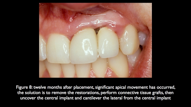 The Challenge of Replacing Missing Central and Lateral Incisors Frank Spear The Challenge of Replacing Missing Central and Lateral Incisors Figure 8