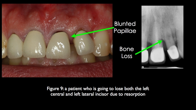 The Challenge of Replacing Missing Central and Lateral Incisors Frank Spear The Challenge of Replacing Missing Central and Lateral Incisors Figure 9