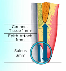 Frank Spear The Two Rules of Subgingival Margin Placement image2