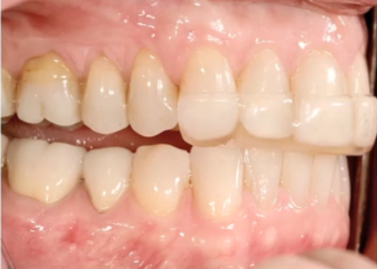 Tooth Wear Appliances: Anterior Bite Planes Frank Spear Tooth Wear Appliances Featured Image