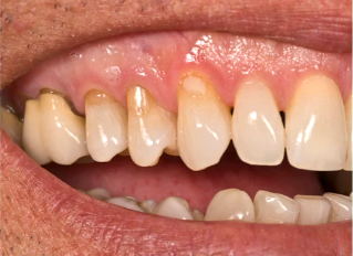 Treating Class V Lesions Frank Spear Treating Class V Lesions Image 1