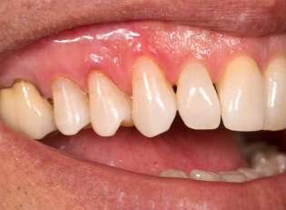 Treating Class V Lesions Frank Spear Treating Class V Lesions Image 2