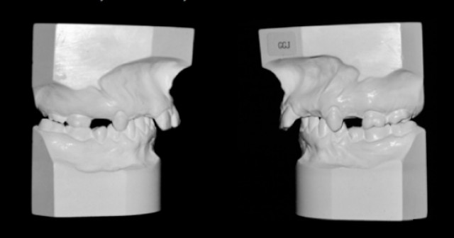 A Guide to Anterior Open Bites