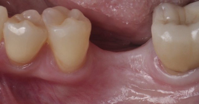 Gonzalo Blasi Alveolar Ridge Featured image