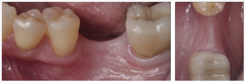 Gonzalo Blasi Alveolar Ridge Fig 1