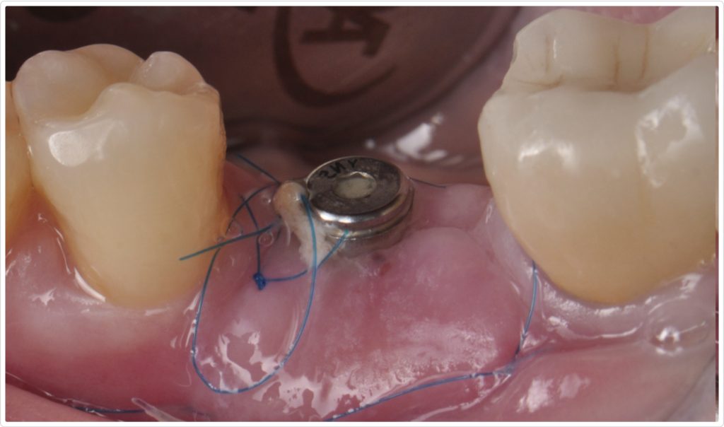 Gonzalo Blasi Alveolar Ridge Fig 11
