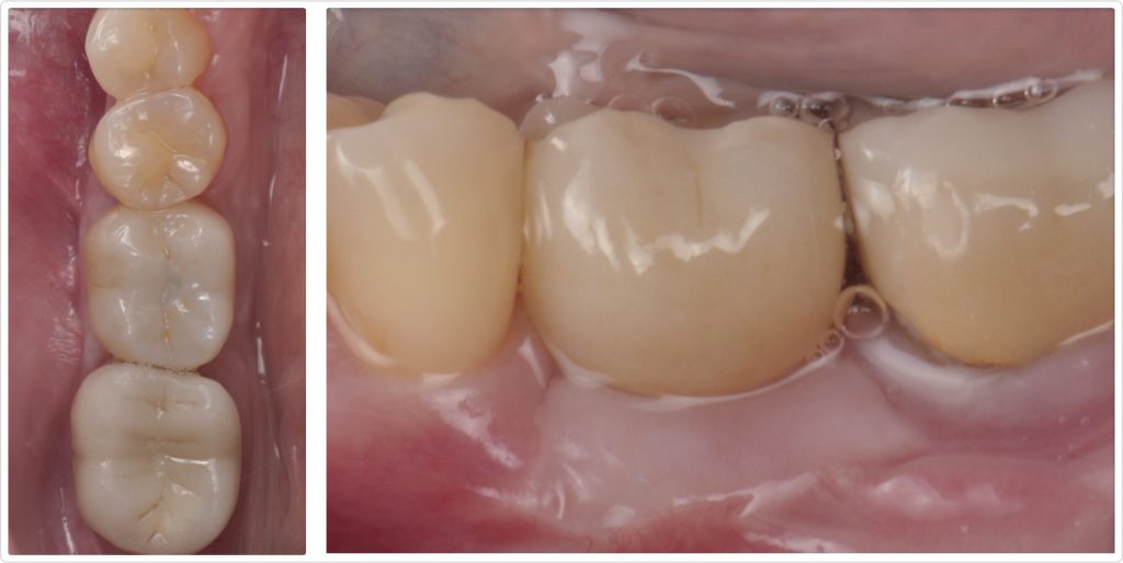 Gonzalo Blasi Alveolar Ridge Fig 12