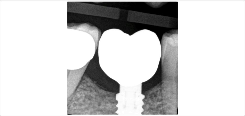 Gonzalo Blasi Alveolar Ridge Fig 13