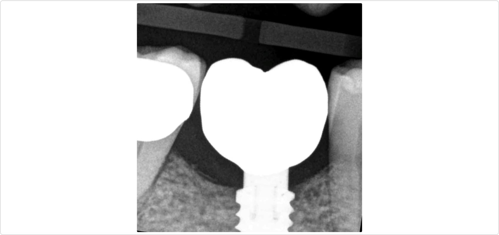 Comprehensive Alveolar Ridge Augmentation and Implant Placement: A Case ...