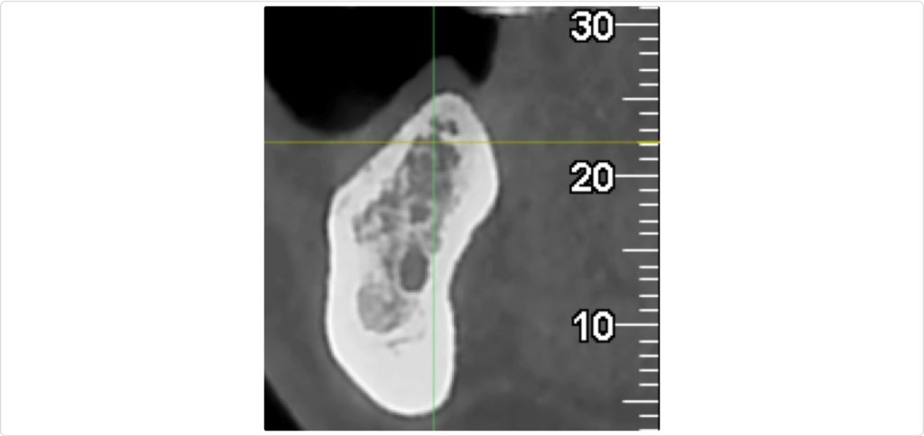 Gonzalo Blasi Alveolar Ridge Fig 2
