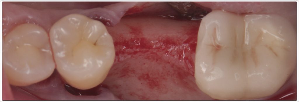 Gonzalo Blasi Alveolar Ridge Fig 3