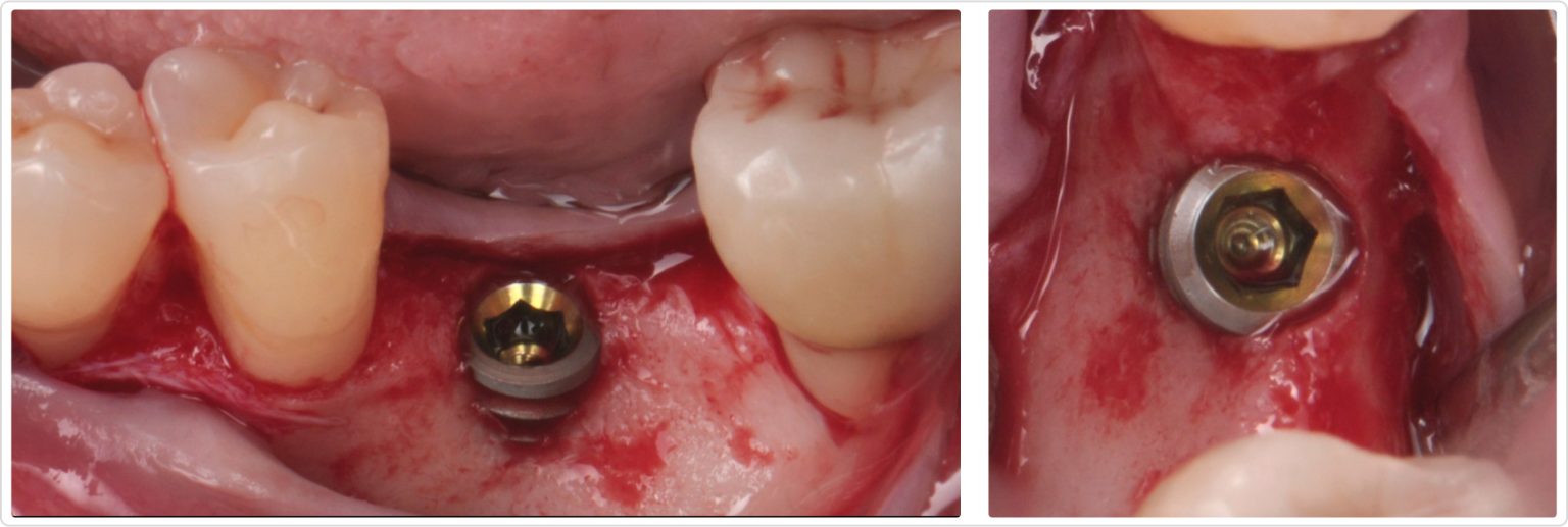 Comprehensive Alveolar Ridge Augmentation and Implant Placement: A Case ...