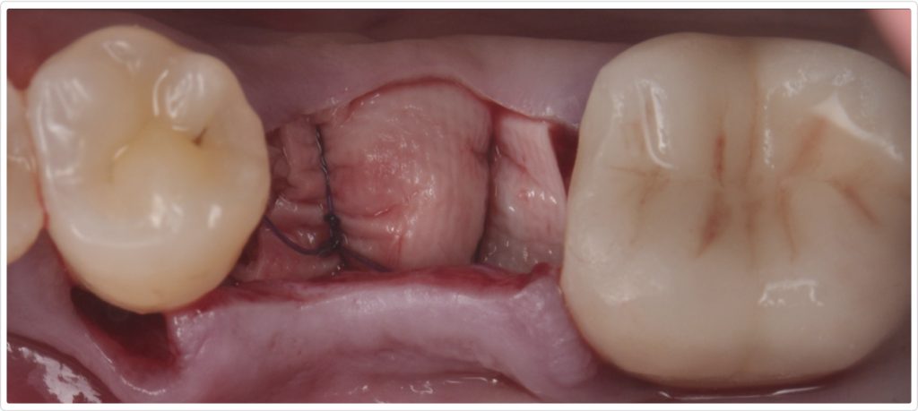 Gonzalo Blasi Alveolar Ridge Fig 5