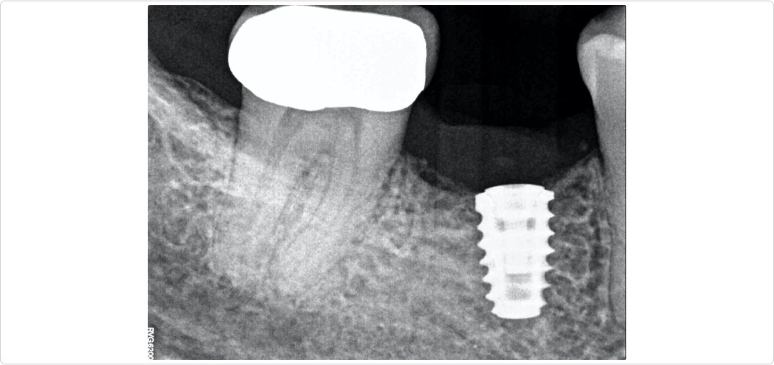 Comprehensive Alveolar Ridge Augmentation and Implant Placement: A Case ...