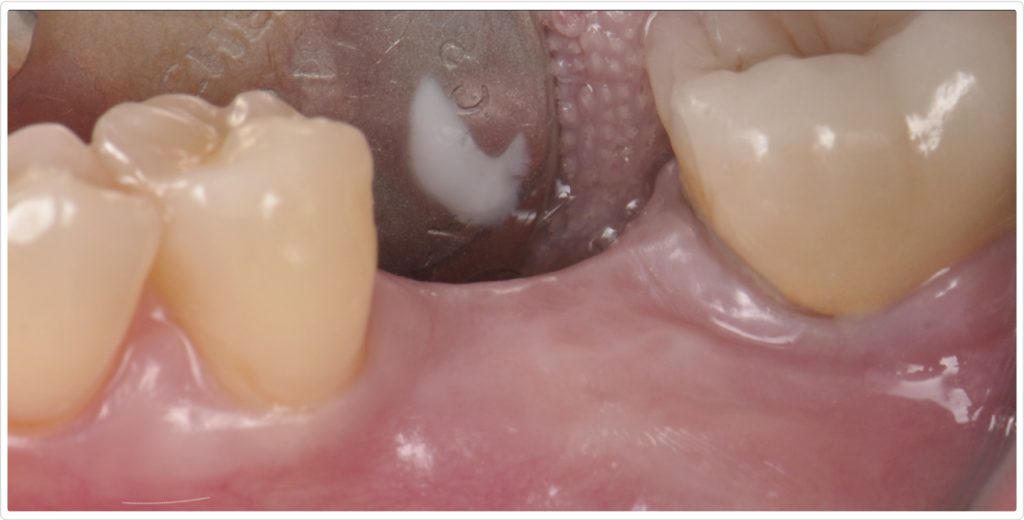 Gonzalo Blasi Alveolar Ridge Fig 8