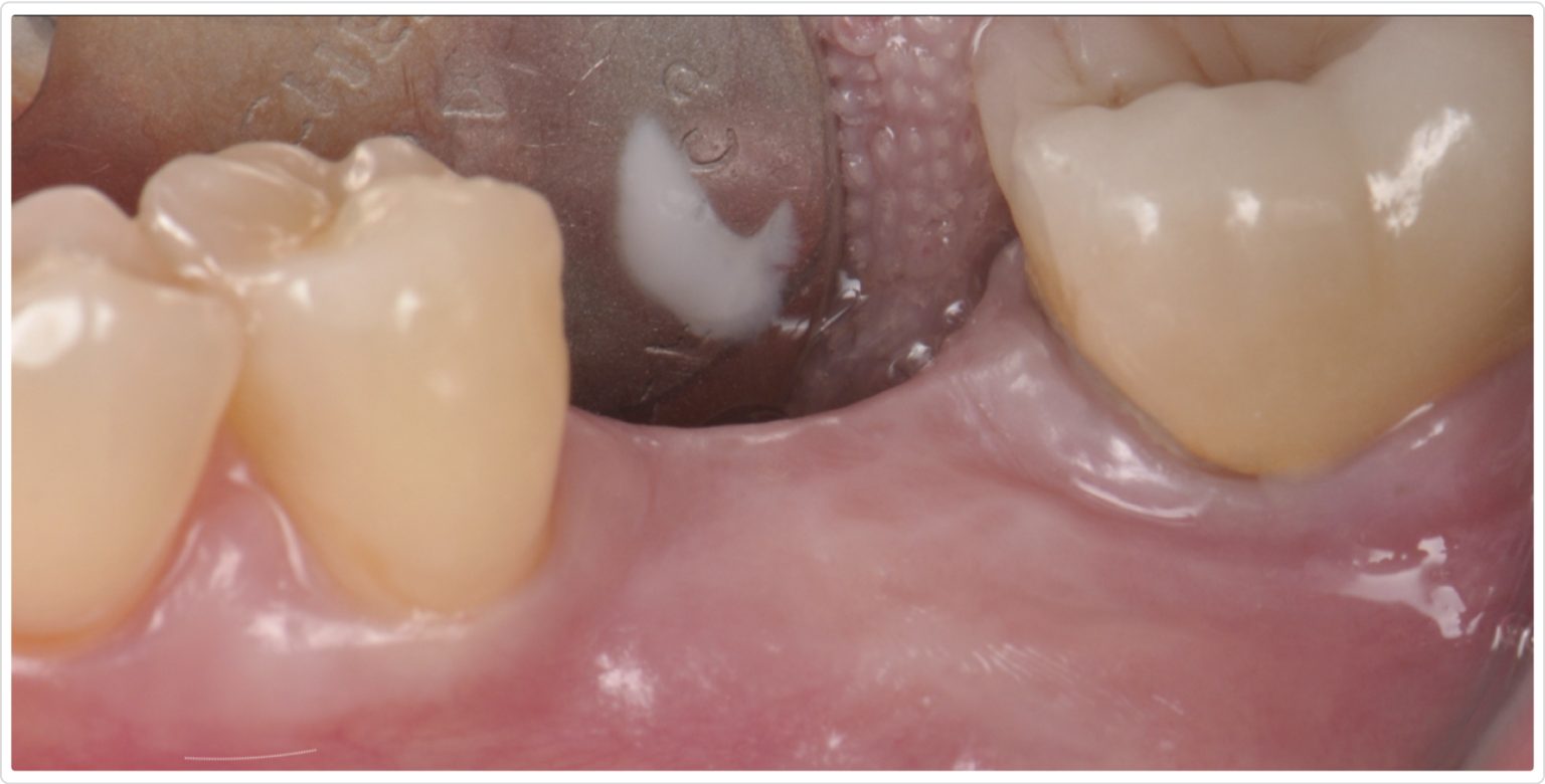 Comprehensive Alveolar Ridge Augmentation and Implant Placement: A Case ...
