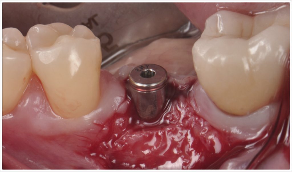 Gonzalo Blasi Alveolar Ridge Fig 9