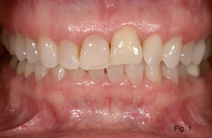 Ankylosis Part II: Treating Adults With an Ankylosed Tooth Gregg Kinzer Ankylosis Part II Figure 1