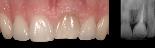 Ankylosis Part II: Treating Adults With an Ankylosed Tooth Gregg Kinzer Ankylosis Part II Figure 2