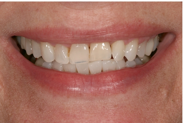 Ankylosis Part II: Treating Adults With an Ankylosed Tooth Gregg Kinzer Ankylosis Part II Figure 3