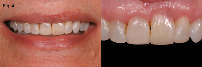 Ankylosis Part II: Treating Adults With an Ankylosed Tooth Gregg Kinzer Ankylosis Part II Figure 4