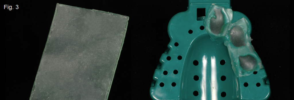 'Closed Tray' vs. ‘Open Tray' Implant Impressions Gregg Kinzer Closed Tray vs Open Tray Figure 3