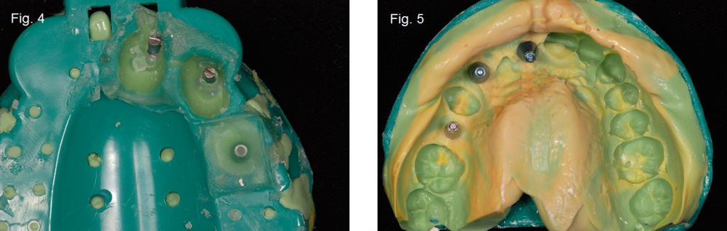 'Closed Tray' vs. ‘Open Tray' Implant Impressions Gregg Kinzer Closed Tray vs Open Tray Figure 5
