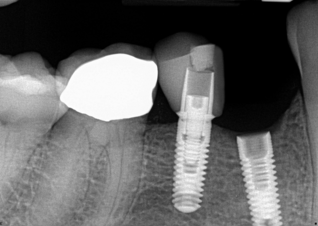 Why Implant Restoration Screws Become Loose Gregg Kinzer Why Implant Restoration Screws Become Loose Figure 1