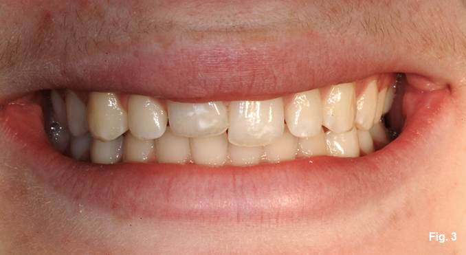 Greggory Kinzer Ankylosis Part III fig3