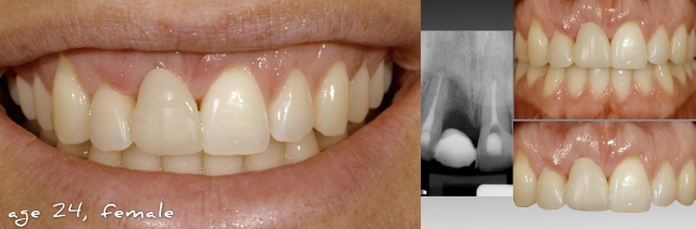 Does Facial Growth Continue as We Age? Greggory Kinzer Does Facial Growth Continue as We Age Figure 1