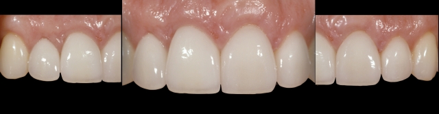 Does Facial Growth Continue as We Age? Greggory Kinzer Does Facial Growth Continue as We Age Figure 2