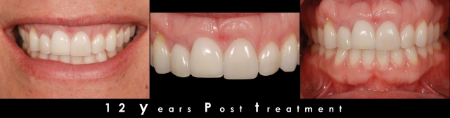 Does Facial Growth Continue as We Age? Greggory Kinzer Does Facial Growth Continue as We Age Figure 4