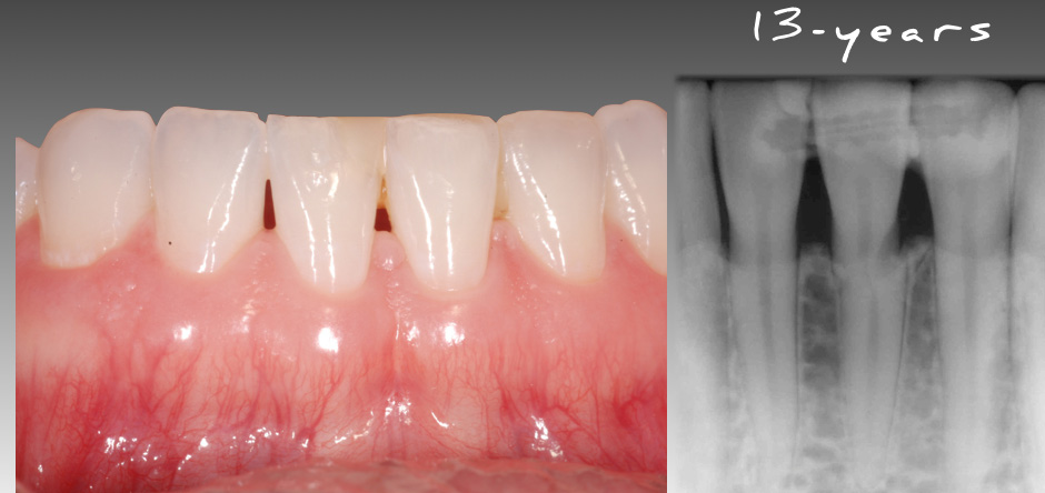 Horizontal Root Fracture: Extract or Retain? Greggory Kinzer Horizontal Root Fracture Extract or Retain Fig3