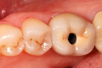 Sealing the Screw Access Hole on Screw-Retained Implant Restorations Greggory Kinzer Sealing the Screw Access Hole Featured Image