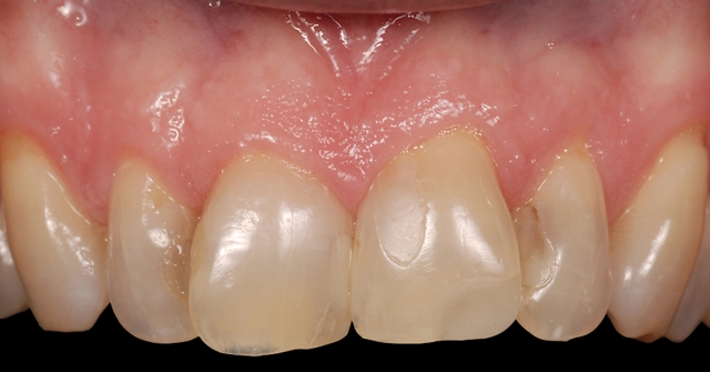 Greggory Kinzer veneer preparations when to break interproximal contact Fig 1a