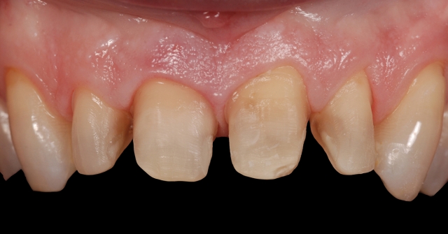 Greggory Kinzer veneer preparations when to break interproximal contact Fig 1b