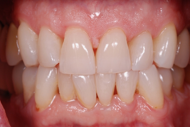 Greggory Kinzer veneer preparations when to break interproximal contact Fig 2a