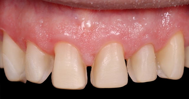 Greggory Kinzer veneer preparations when to break interproximal contact Fig 2b
