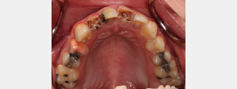 An Introduction to Silver Diamine Fluoride