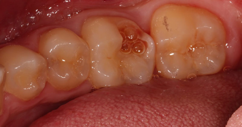 Pulp Capping: Can We and Should We? Janiga pulp capping should we 01