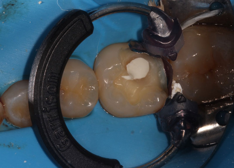 Pulp Capping: Can We and Should We? Janiga pulp capping should we 03