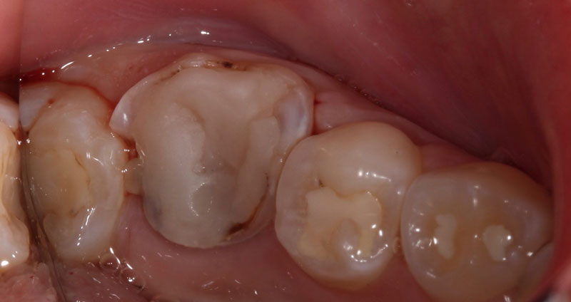 Pulp Capping: Can We and Should We? Janiga pulp capping should we 05