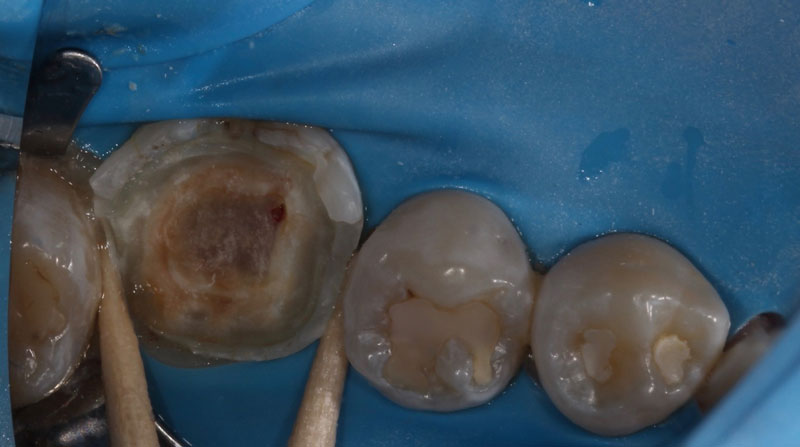 Pulp Capping: Can We and Should We? Janiga pulp capping should we 06