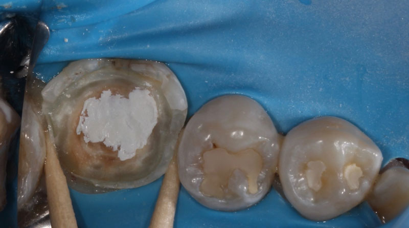 Pulp Capping: Can We and Should We? Janiga pulp capping should we 07